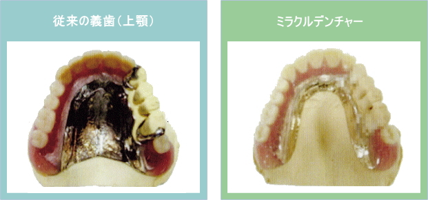 ミラクルデンチャー