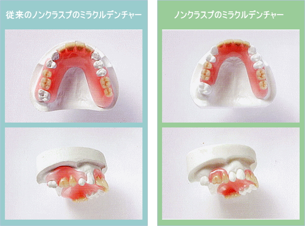 ミラクルデンチャー