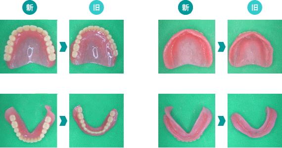 入れ歯の比較