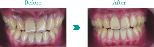 歯肉の黒ずみの治療